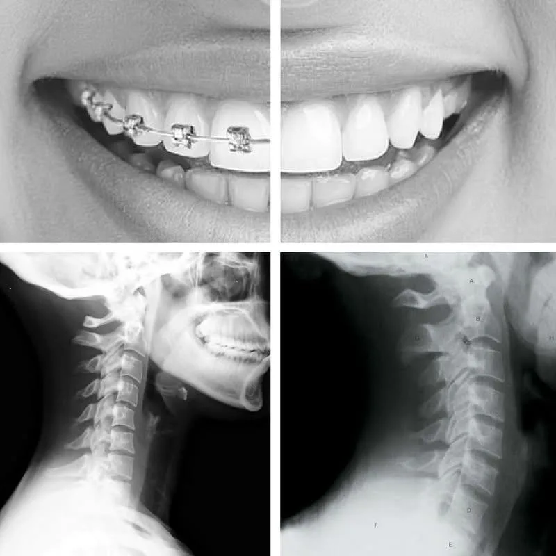 A four-panel comparison: teeth before and after braces on top, and cervical-spine X-rays before and after structural correction below — showing how corrective chiropractic care realigns the spine much as braces realign teeth.